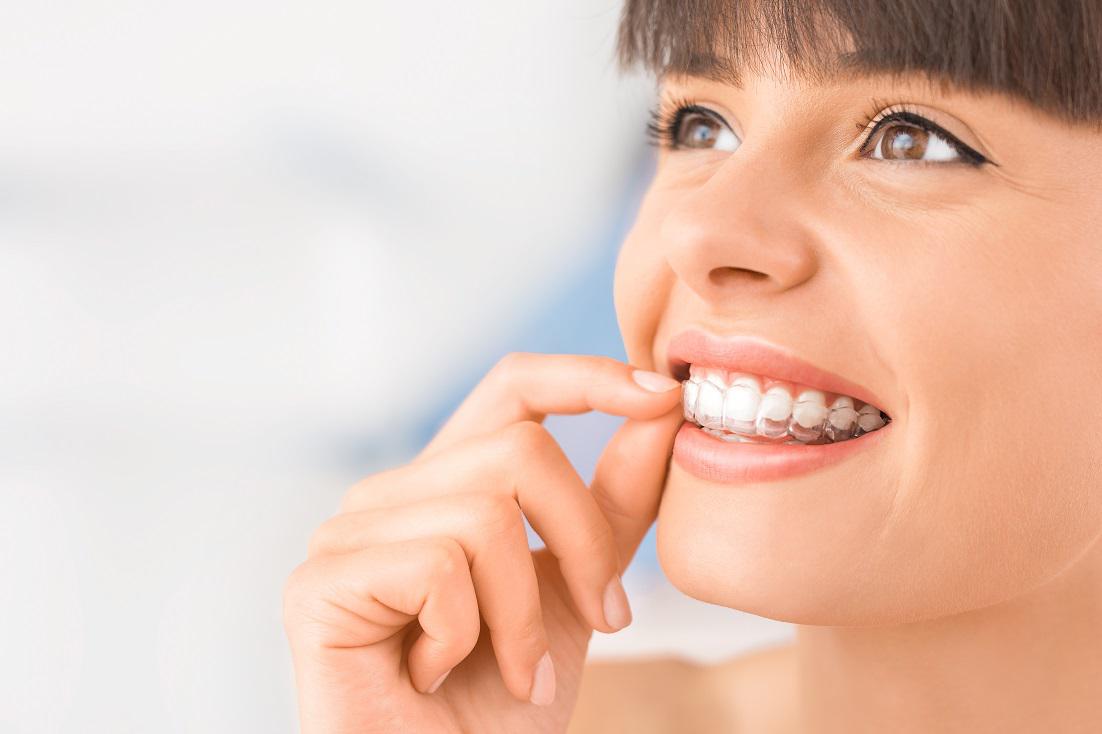 Why Invisalign Is the Top Choice for Teenagers' Orthodontic Journey