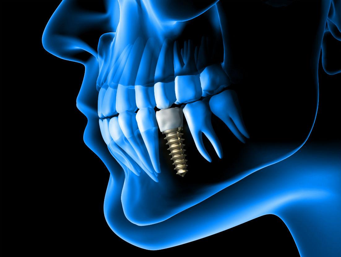 Dental Implants San Pablo CA