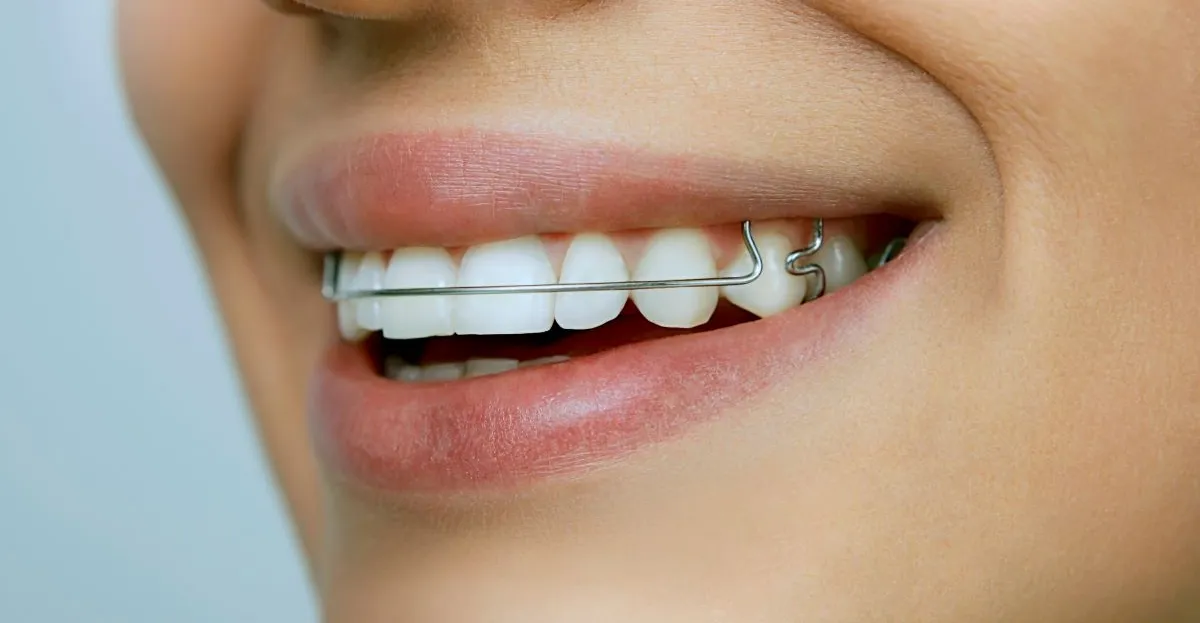 Why Your Retainer Matters During Summer Break