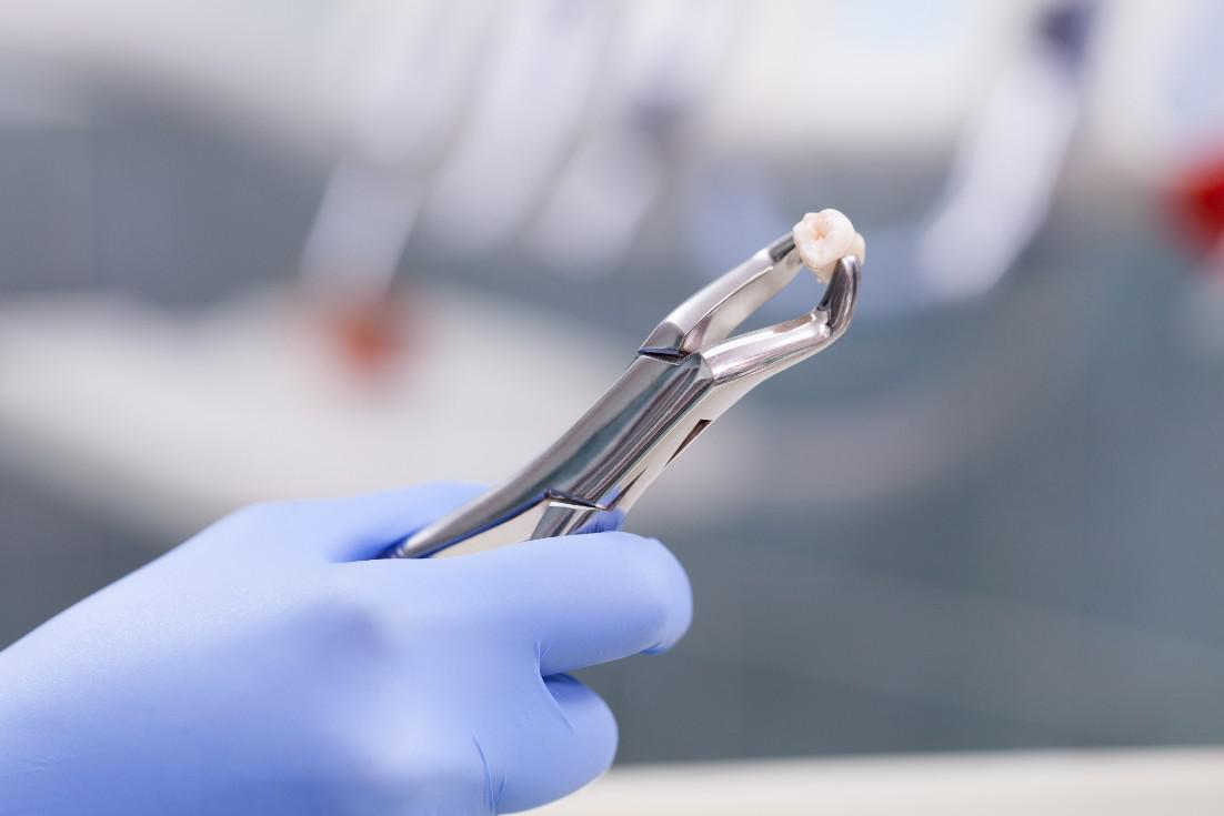 5 Common Reasons for a Tooth Extraction