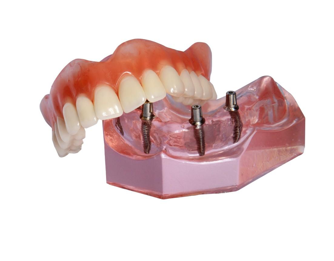 Dental Implants San Pablo, CA